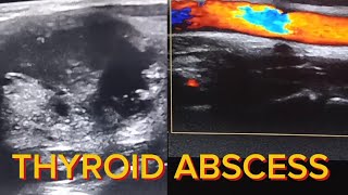 quotThyroid Abscess Ultrasound [upl. by Ainattirb]