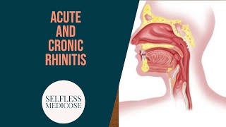 CHRONIC RHINITIS part 5 rhinitis sicca and rhinitis caseosa easy explanation [upl. by Larrabee]