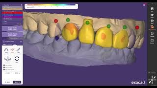 Zircon Coping Design in Exocad [upl. by Os337]