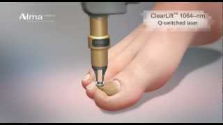 ClearChoice Latest Nail Restoration Technology Nail Fungus Treatment [upl. by Ahteres]