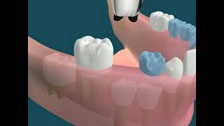 Dental Video for Space Maintainer  The Tooth [upl. by Nesyla]