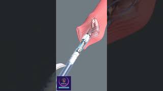 Laparoscopic Esophageal Surgery [upl. by Ahsienek]