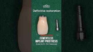 Cementless implant prosthesis highness [upl. by Sidonia538]