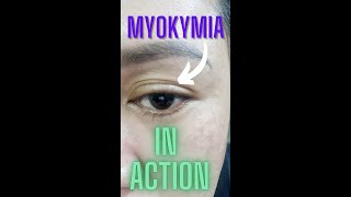 SEE MYOKYMIA IN ACTION  Eyelid Twitching shorts [upl. by Koeninger]