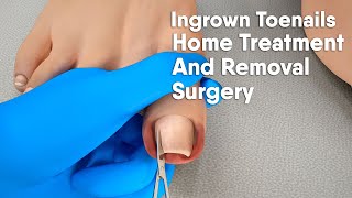 Ingrown toenail Home treatment and removal surgery3d animation [upl. by Anihcak]