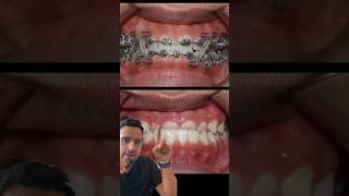 Cas ORTHODONTIE  l’INVERSÉ d’occlusion DENTAIRE [upl. by Munroe]