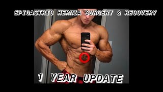 EPIGASTRIC HERNIA SURGERY amp RECOVERY 1 YEAR UPDATE [upl. by Enomas]