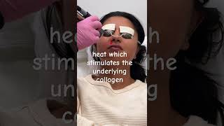 Collagen Production with Instant Glow Laser Facial ✨ laserfacial collagen laseraway [upl. by Bittencourt]