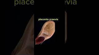 Placenta praevia shorts anatomy placentaprevia placenta gynecology [upl. by Edlihtam]