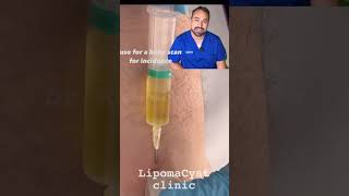 Bakers cyst treatment skincare dr Khaled Sadek explains [upl. by Ynohtna]