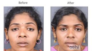 Ptosis droopy eyelidTreatment and surgery blepharoplasty by Dr Akshay Nair AEHI Mumbai [upl. by Carl]