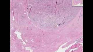 Histopathology ProstateAdenocarcinoma [upl. by Ysdnil319]