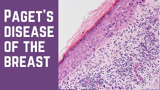 Pagets Disease of the Breast  Pathology mini tutorial [upl. by Newob]