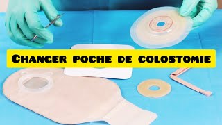 changer poche de colostomie [upl. by Anirav]