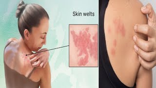 Urticaria amp Angioedema  Part 1  Dermatology [upl. by Sewellyn]