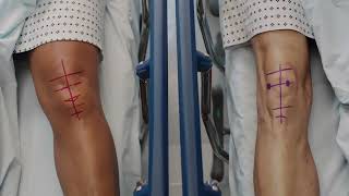 If Your Knees Could Talk  Conformis Fully Personalized Knee Replacement [upl. by Naimad]