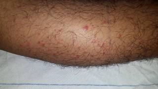 Palpable Purpura HSP  Henoch  Schonlein Purpura [upl. by Kannan]