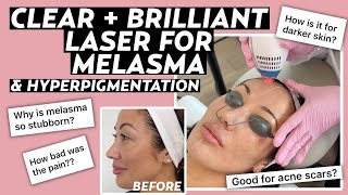 Clear  Brilliant Laser for Melasma Dermatologist Answers FAQs with Before amp After Results [upl. by Allehcim]