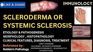 Scleroderma  Systemic Sclerosis [upl. by Roose]