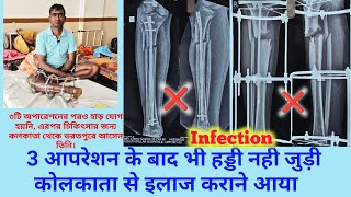 tibia fibula and femur fracture ilizarov surgery fail kolkata se bharatpur ilaaj ke liye aaya [upl. by Corbet]