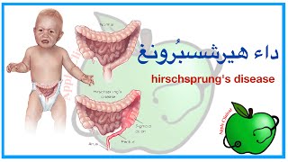 Hirschsprung Disease مرض الهرشبسرونج [upl. by Bradly623]