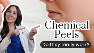 The Dos amp Donts of Chemical Peels [upl. by Enaej]