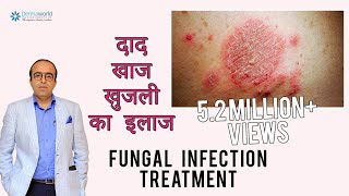 फ़ंगस इनफ़ेक्शन दिनाय दाद खाज का इलाज  Treating Fungal Infection In HINDI  Dr Rohit Batra [upl. by Anthe]