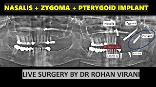 NASALIS  ZYGOMA  PTERYGOID IMPLANT  LIVE SURGERY BY DR ROHAN VIRANI [upl. by Zahara]