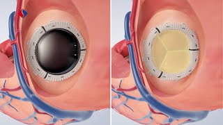 Mitralklappeninsuffizienz OP  Medizinische Animation [upl. by Nyleve492]