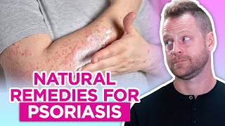 How to Get Rid of Psoriasis – Natural Remedies for Psoriasis [upl. by Cleodell]