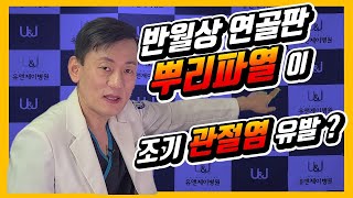 무릎 반월상연골판 후방기시부파열 뿌리파열 정의 진단 [upl. by Annatnas]