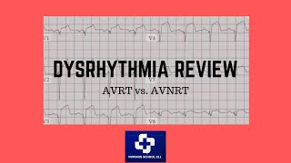 Dysrhythmia Review AVRT vs AVNRT [upl. by Ahsenyl]