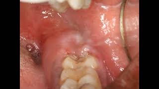 Operculectomy procedure with blade Painful swollen gum around wisdom tooth Pericoronitis Treatment [upl. by Murdocca]