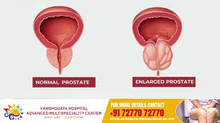 Understanding Frequent Micturition Dr Somashekar  Vamshodaya Hospitals [upl. by Nylcoj]