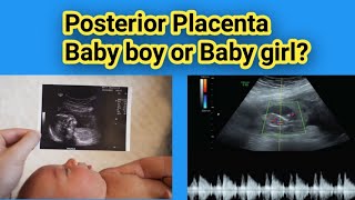 Posterior placenta Baby boy or Baby Girl Gender Prediction Radiology vibes [upl. by Thoma939]