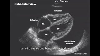 Efusion Pericardica [upl. by Rafaelita916]
