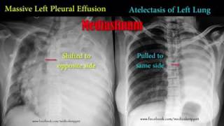 Ventricular Bigeminy [upl. by Eal]