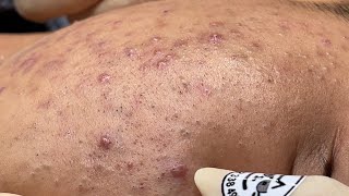 Blackheads amp Pimples Pore Removal New 2024FULL  Acne Treatment With Bo Nguyễn Spa [upl. by Kent]