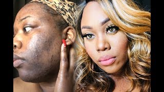 Acne makeup tutorial for brown skin severe hyperpigmentation makeup coverup [upl. by Jecho]