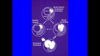 ISTH Academy Presentation Arterial Thrombosis Pathogenesis Epidemiology [upl. by Yerdna]