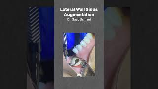 Lateral Wall SInus Augmentation  Simulation HandsOn Session with Dr Saad [upl. by Assyral910]