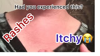 2 Best Home Remedies For ITCHY SCALP TREATMENT [upl. by Reina]