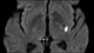 Acute lacunar infarction basal ganglia [upl. by Odnalor]