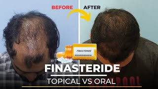 Oral vs Topical Finasteride  Which is the best for Hair Growth  Hair Clinic in Delhi [upl. by Jakie]