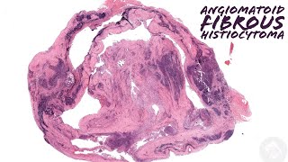 Angiomatoid fibrous histiocytoma Australasian Dermpath 2022  Case 7 pathology dermatology [upl. by Jobey]