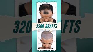 3200 Grafts Hair Transplant  Bangladesh hairtransplant hairtransplantation bangladesh shorts [upl. by Abbub]