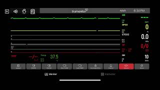 Primary Ventricular Standstill P wave Asystole [upl. by Warren120]