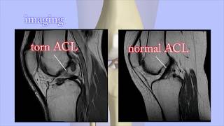 Lateral Ankle Sprain [upl. by Darej989]