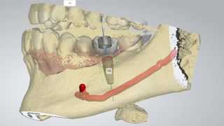 Digital Implant Dentistry [upl. by Rrats]