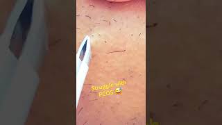 Plucking Facial Hair Womens Beard Removal Tweezers  PCOS Warrior  Got Rid of my PCOS Facial Hair [upl. by Jew]